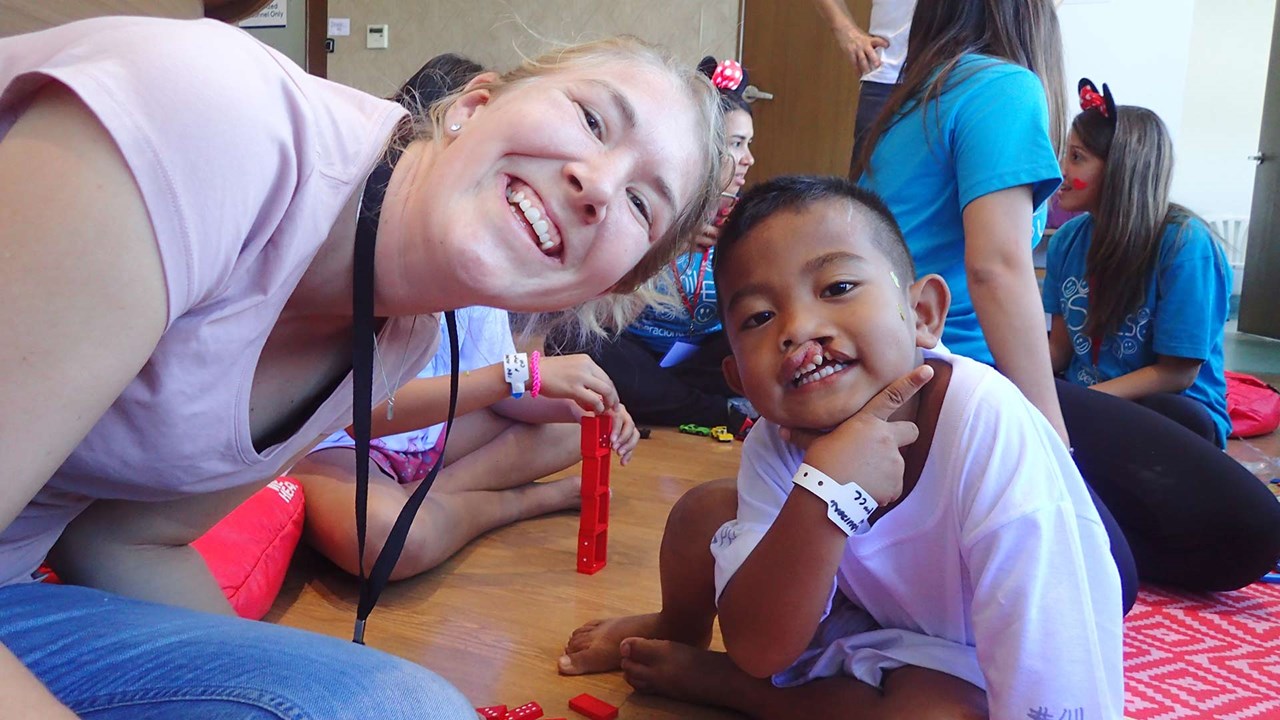 a child with cleft lip in Ilolilo